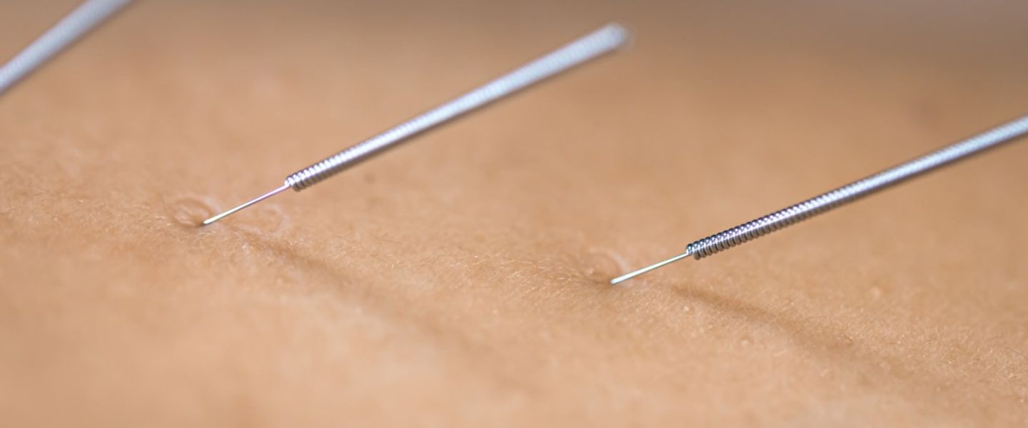 Did you know acupuncture has been practiced for over 2,500 years? Many say they feel like a 'human pin cushion'! #Acupuncture